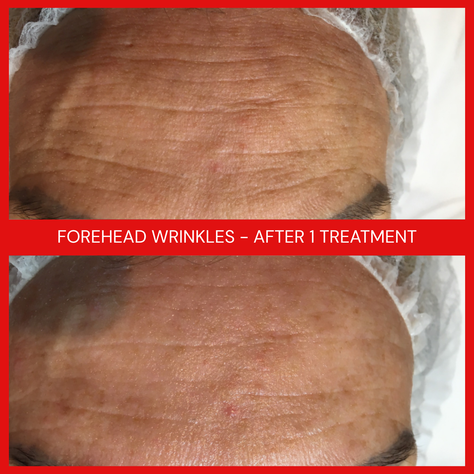 natural organic european micro current transdermalporation electroporation facial elapromed wrinkles, toning, eczema, psoriasis, inflammation, irritation, acne, scarring, stretch marks, cellulite, pigmentation, anti-aging winnipeg esthetics