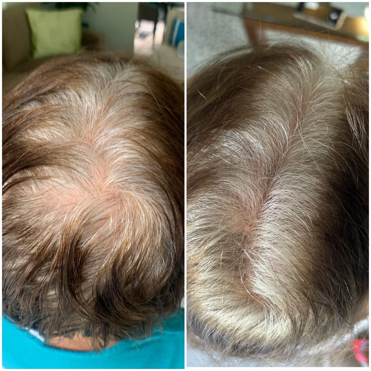 natural organic hair restoration hair increase hair density, thinning hair treatments, prevent stop hair loss, with elapromed microcurrent electroporation,dry scalp treatments winnipeg osborne, st vital