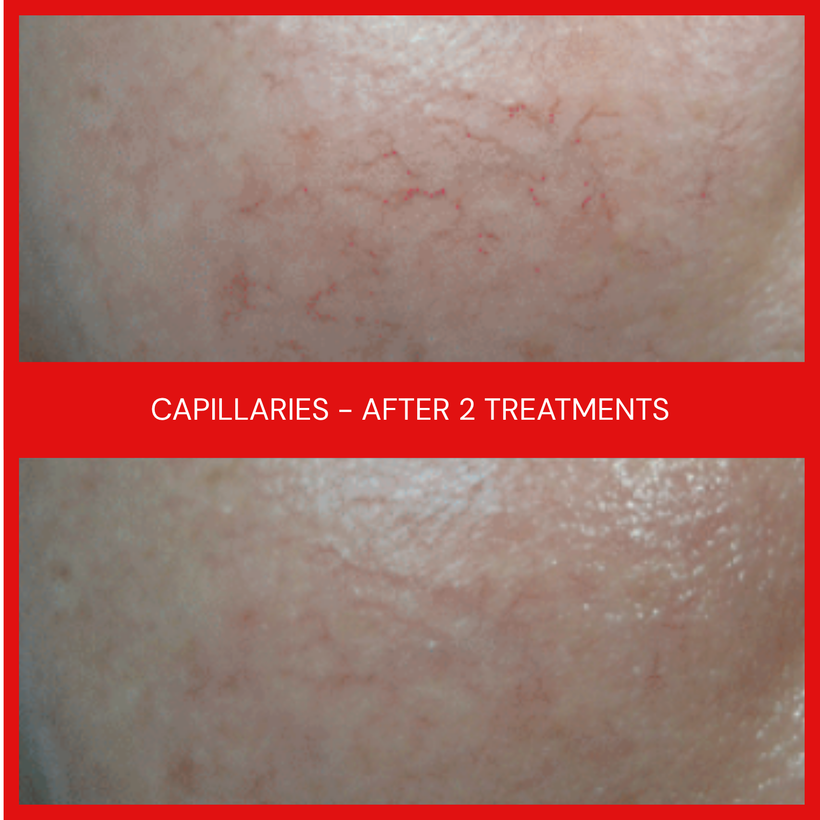 natural organic european micro current transdermalporation electroporation facial elapromed wrinkles, toning, eczema, psoriasis, inflammation, irritation, acne, scarring, stretch marks, cellulite, pigmentation, anti-aging winnipeg esthetics