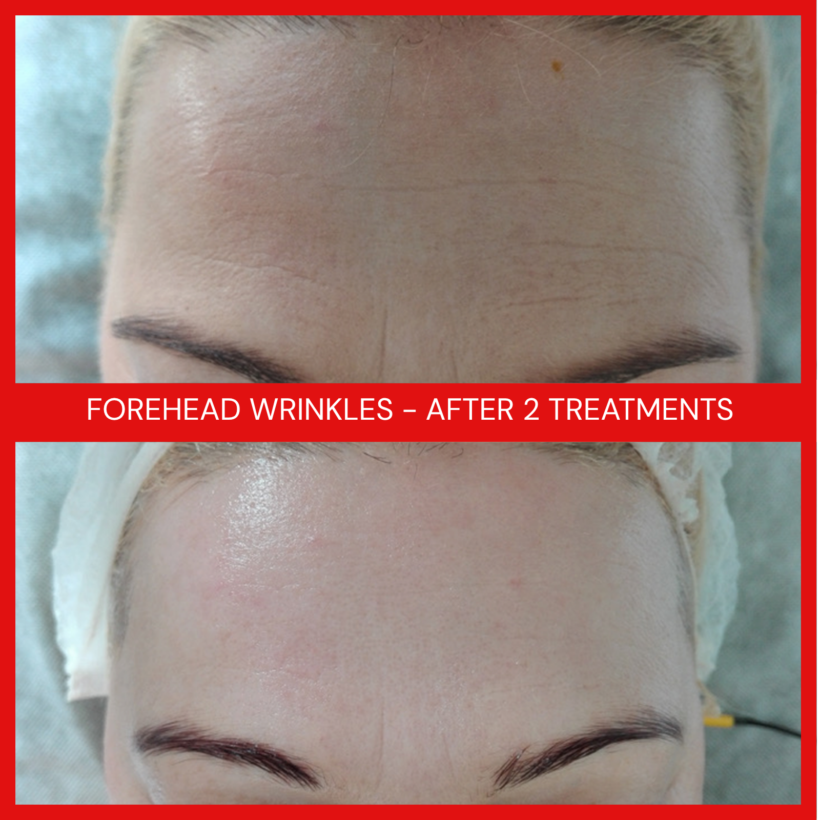 natural organic european micro current transdermalporation electroporation facial elapromed wrinkles, toning, eczema, psoriasis, inflammation, irritation, acne, scarring, stretch marks, cellulite, pigmentation, anti-aging winnipeg esthetics