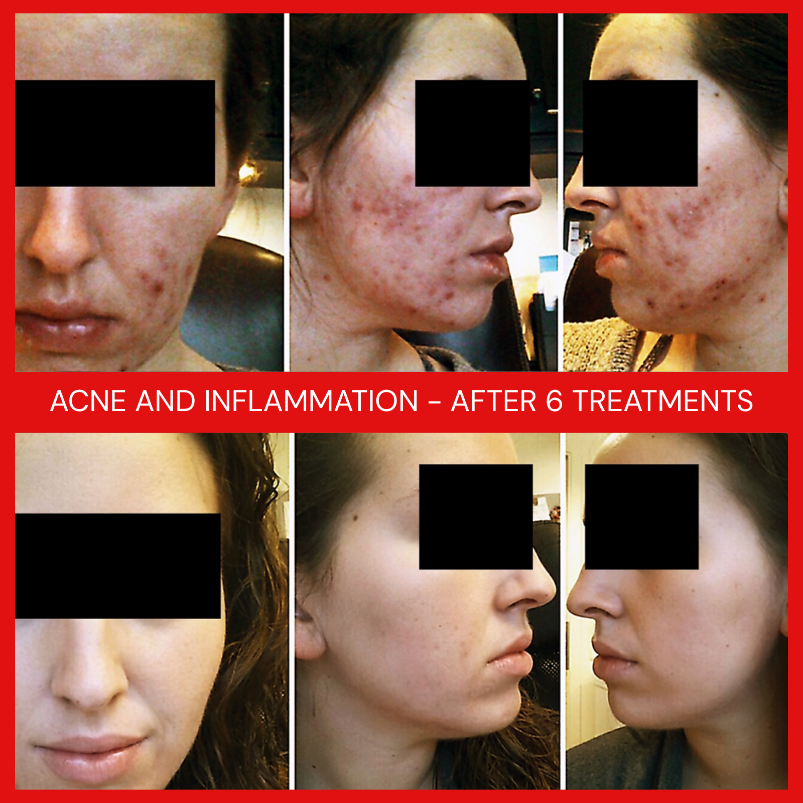 natural organic european micro current transdermalporation electroporation facial elapromed wrinkles, toning, eczema, psoriasis, inflammation, irritation, acne, scarring, stretch marks, cellulite, pigmentation, anti-aging winnipeg esthetics