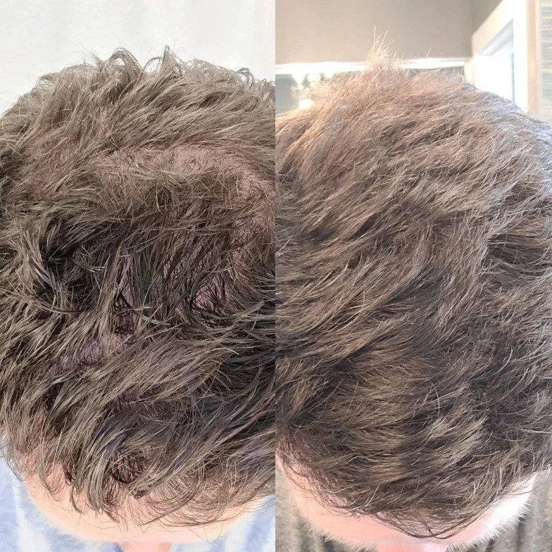 natural organic professional hair restoration hair increase hair density, stop hair loss, thinning hair treatments, prevent hair loss, with elapromed microcurrent electroporation,  winnipeg osborne, st vital