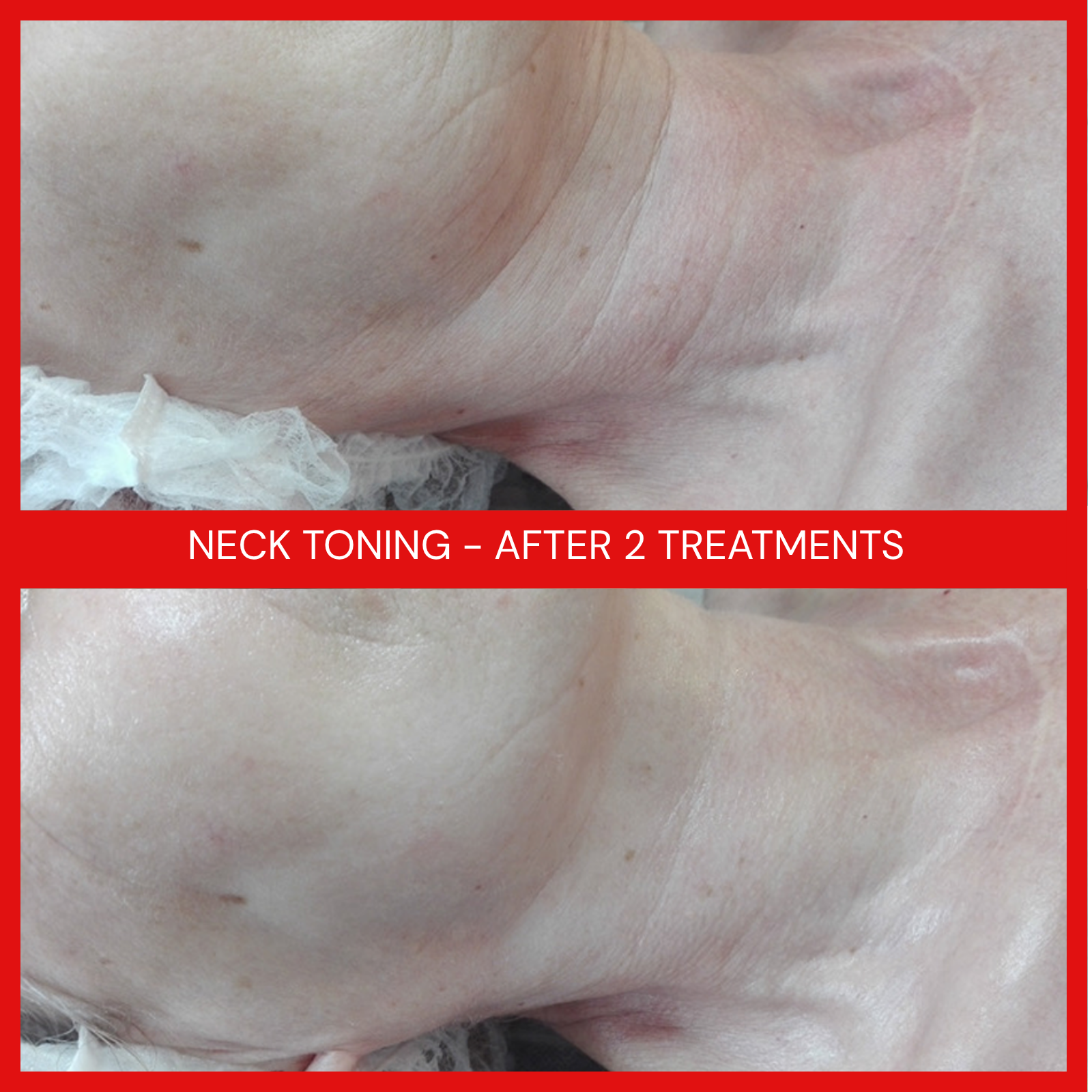 natural organic european micro current transdermalporation electroporation facial elapromed wrinkles, toning, eczema, psoriasis, inflammation, irritation, acne, scarring, stretch marks, cellulite, pigmentation, anti-aging winnipeg esthetics