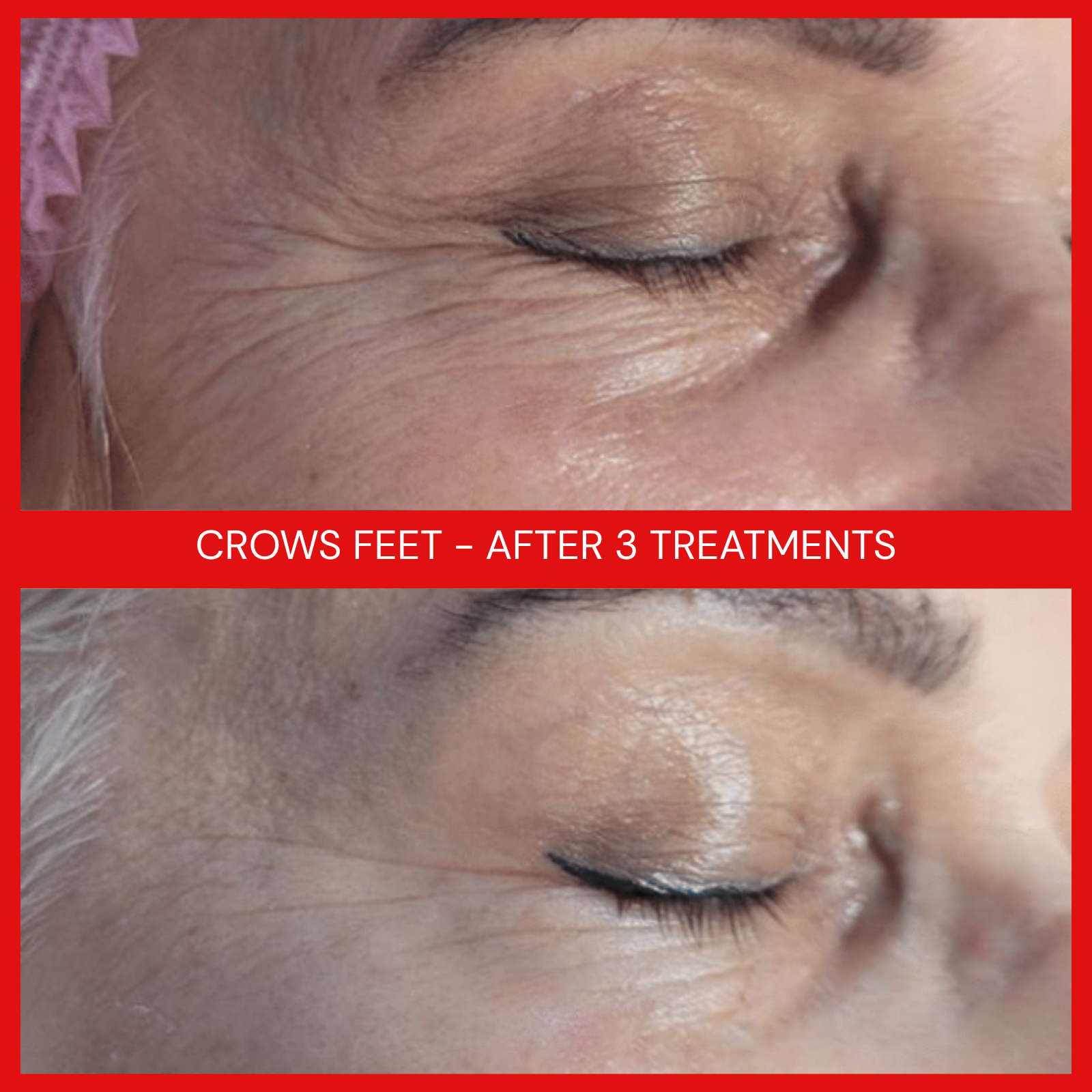 natural organic european micro current transdermalporation electroporation facial elapromed wrinkles, toning, eczema, psoriasis, inflammation, irritation, acne, scarring, stretch marks, cellulite, pigmentation, anti-aging winnipeg esthetics