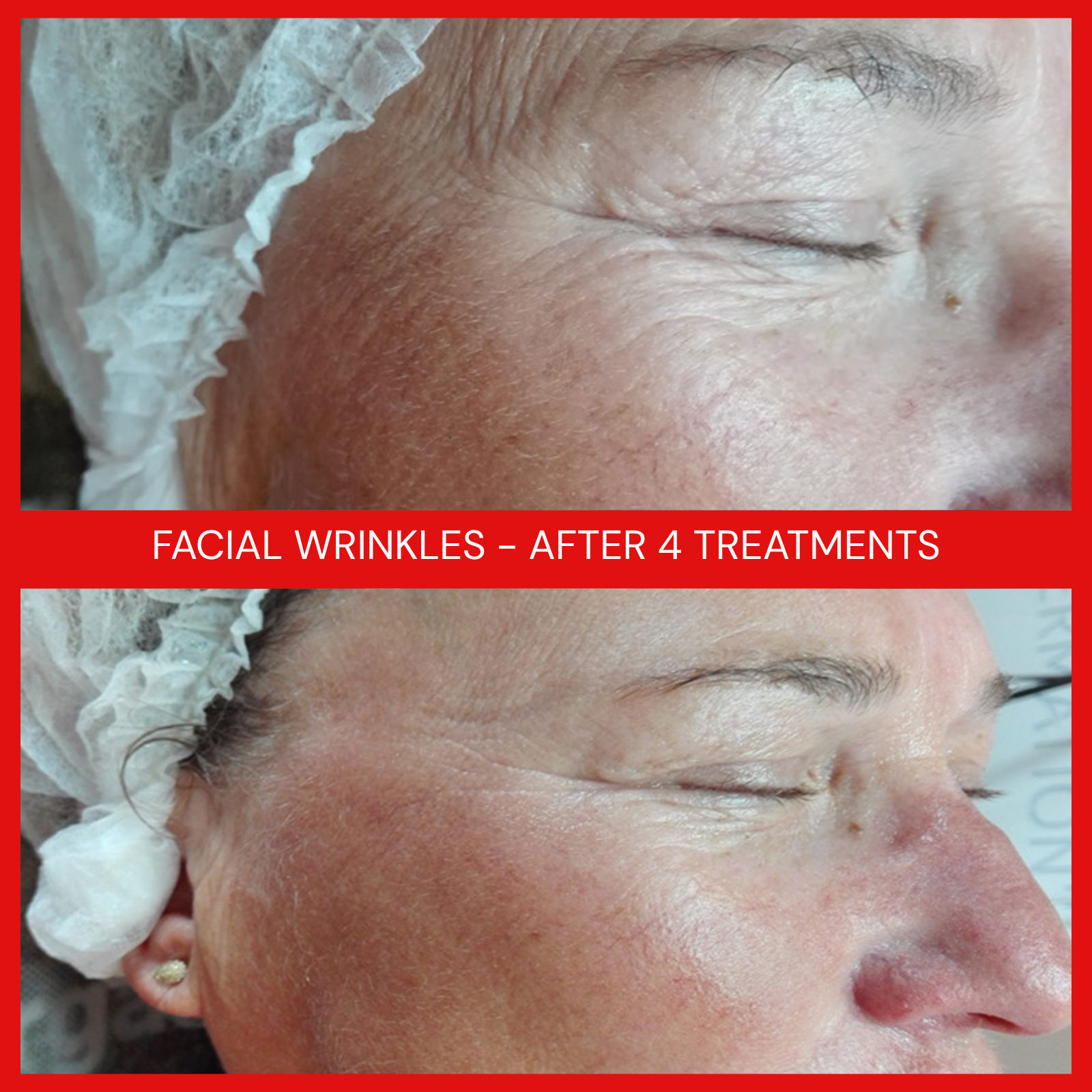 natural organic european micro current transdermalporation electroporation facial elapromed wrinkles, toning, eczema, psoriasis, inflammation, irritation, acne, scarring, stretch marks, cellulite, pigmentation, anti-aging winnipeg esthetics
