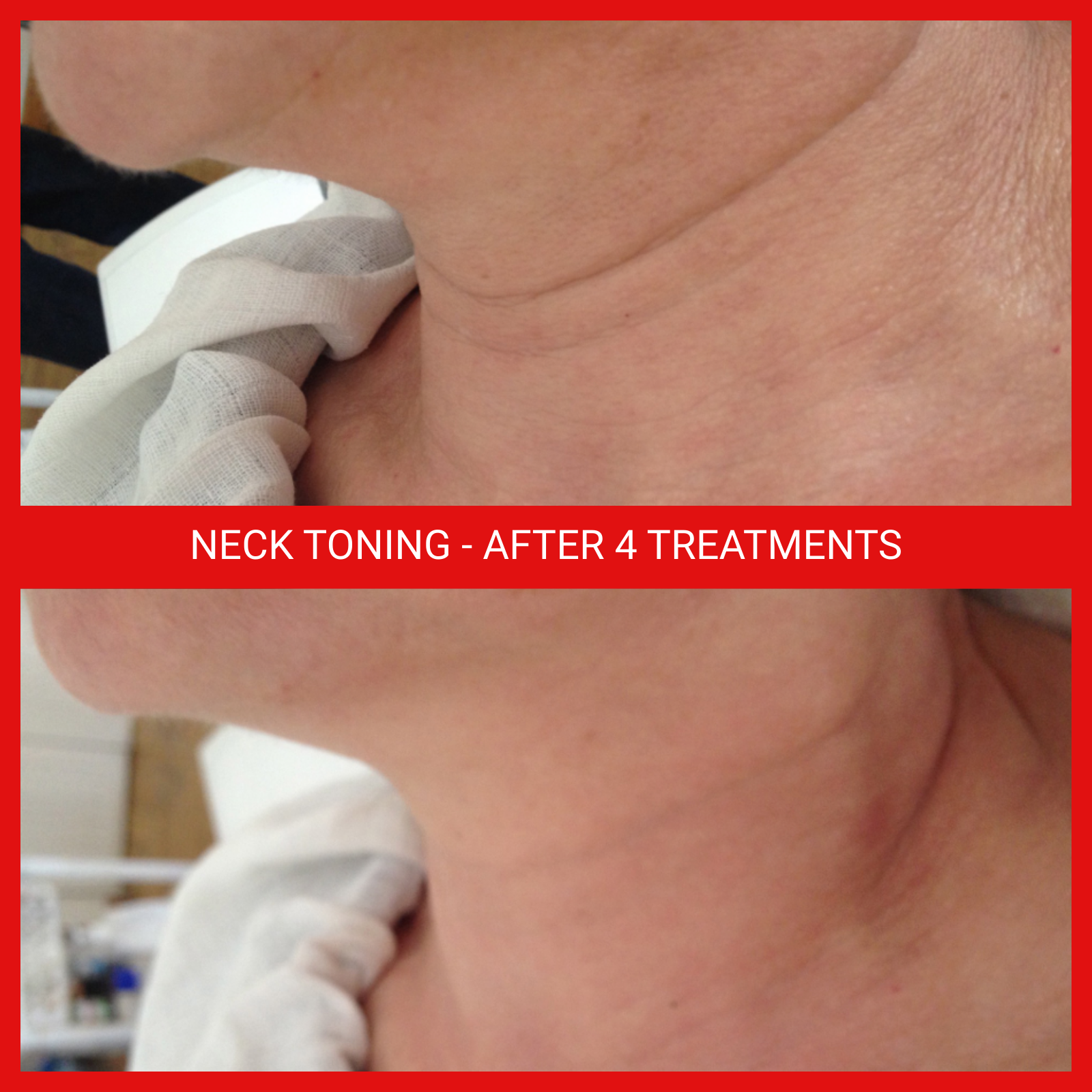neck skin tightening, toning, firming, anti-aging, wrinkle reduction, treatments, winnipeg