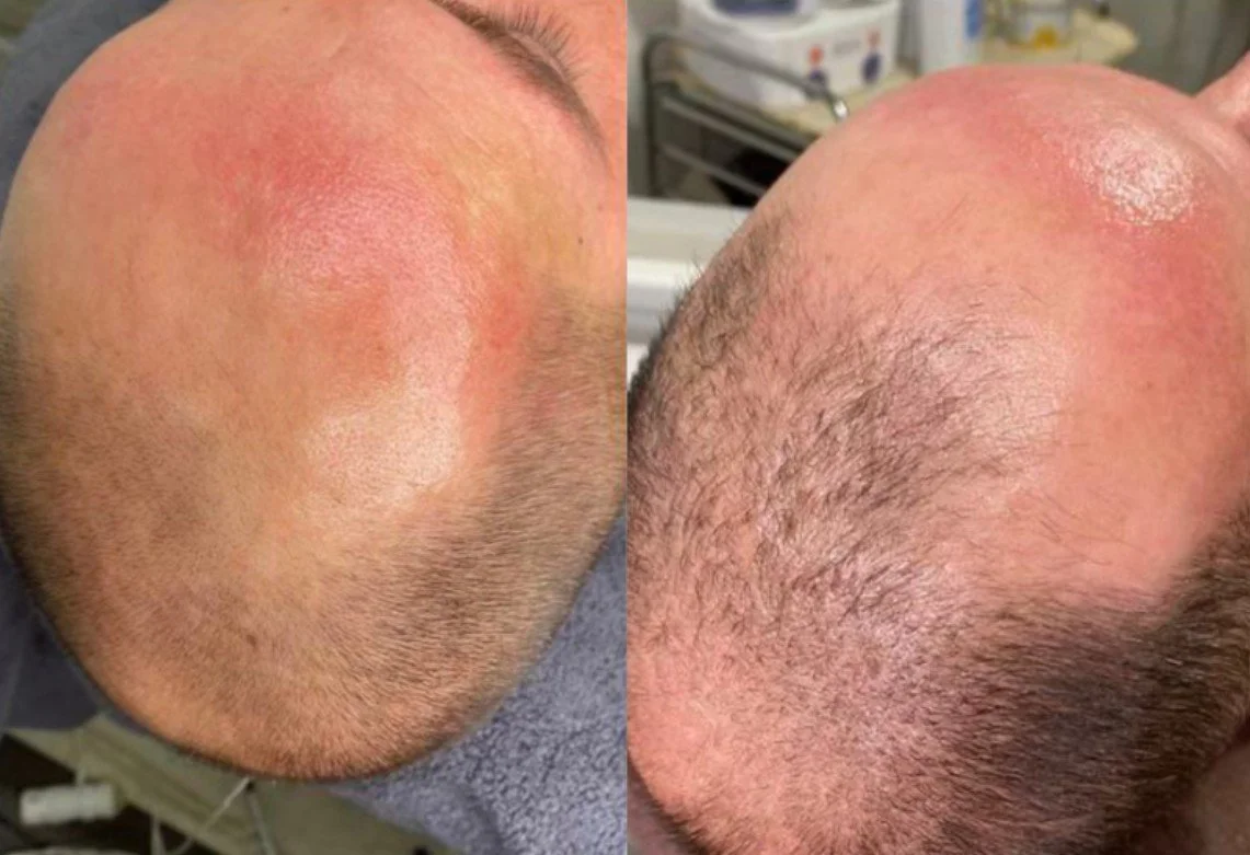 natural organic professional hair restoration hair increase hair density, thinning hair treatments, prevent hair loss, with elapromed microcurrent electroporation, winnipeg osborne, st vital