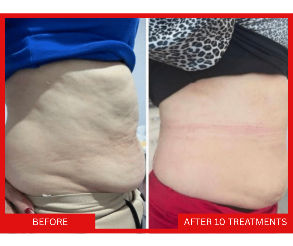 body-shaping-toning-skin-firming-saggy-stretch-mark-cellulite-treatment-winnipeg-osborne-st-vital-pembina-grant