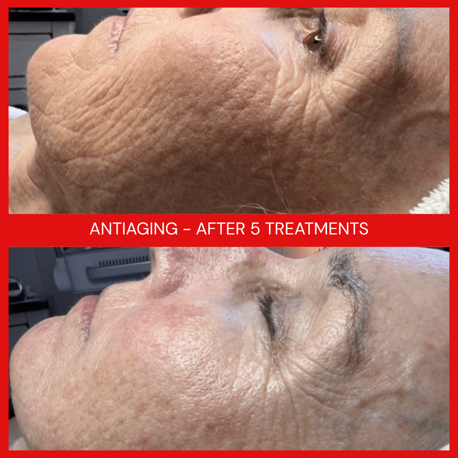 natural organic european medical micro current transdermalporation skin treatments elapromed elaspa wrinkles, toning, eczema, psoriasis, inflammation, irritation, acne, scarring, stretch marks, cellulite, pigmentation, anti-aging winnipeg esthetics