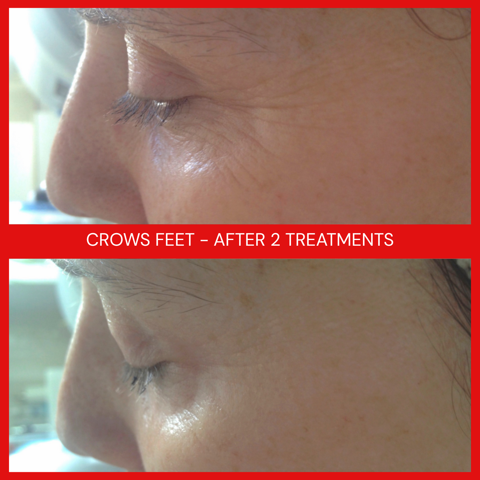 natural organic european micro current transdermalporation electroporation facial elapromed wrinkles, toning, eczema, psoriasis, inflammation, irritation, acne, scarring, stretch marks, cellulite, pigmentation, anti-aging winnipeg esthetics