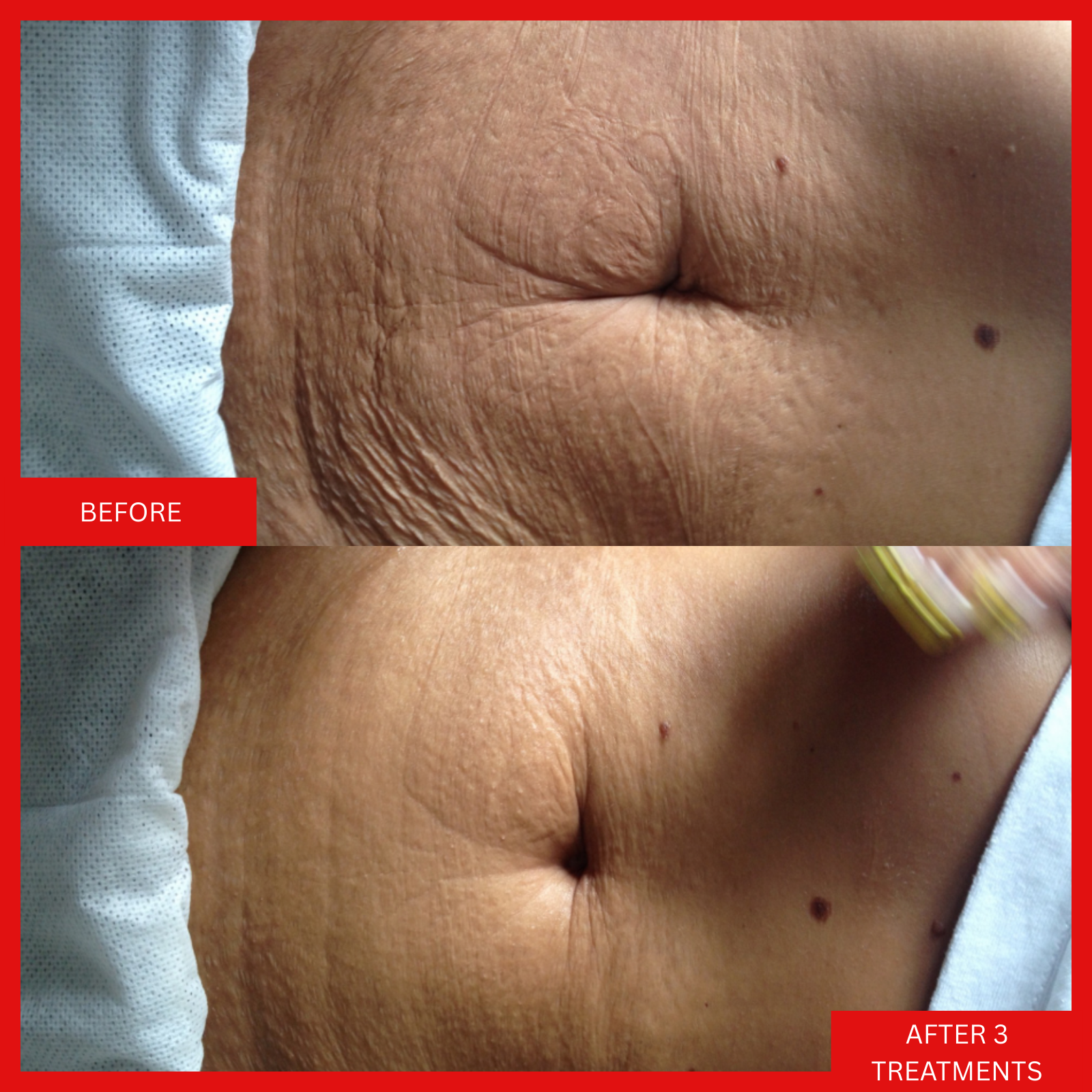 body-shaping-toning-skin-firming-saggy-stretch-mark-cellulite-treatment-winnipeg-osborne-pembina-grant-st-vital