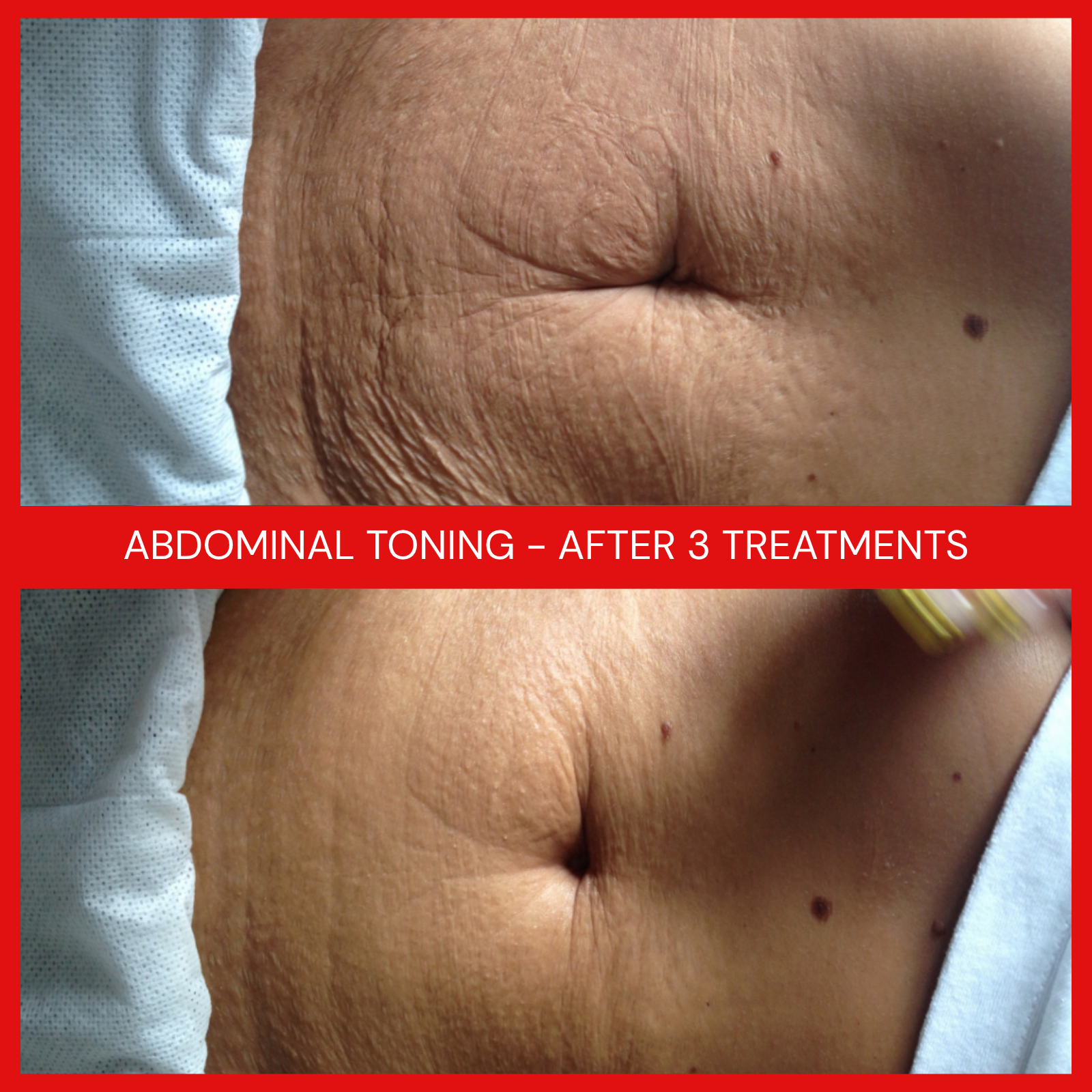 natural organic european micro current transdermalporation electroporation facial elapromed wrinkles, toning, eczema, psoriasis, inflammation, irritation, acne, scarring, stretch marks, cellulite, pigmentation, anti-aging winnipeg esthetics