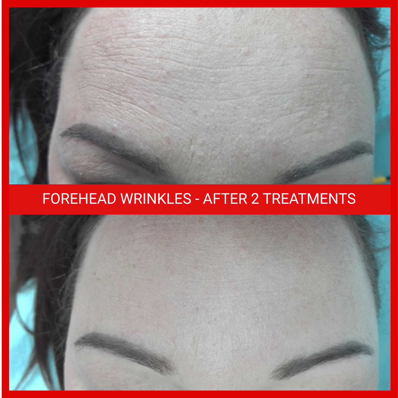 natural organic european medical micro current transdermalporation electroporation facial wrinkles, toning, eczema, psoriasis, inflammation, irritation, acne, scarring, stretch marks, cellulite, pigmentation, anti-aging winnipeg esthetics