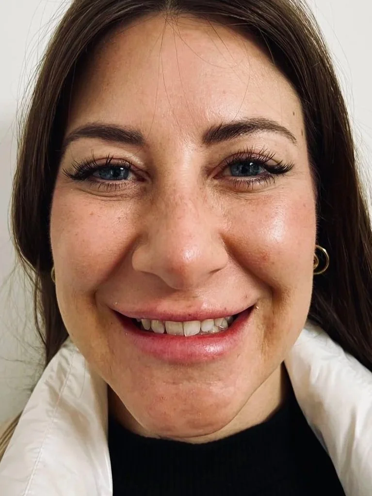 Prima e dopo trattamento con faccette dentali a Bari