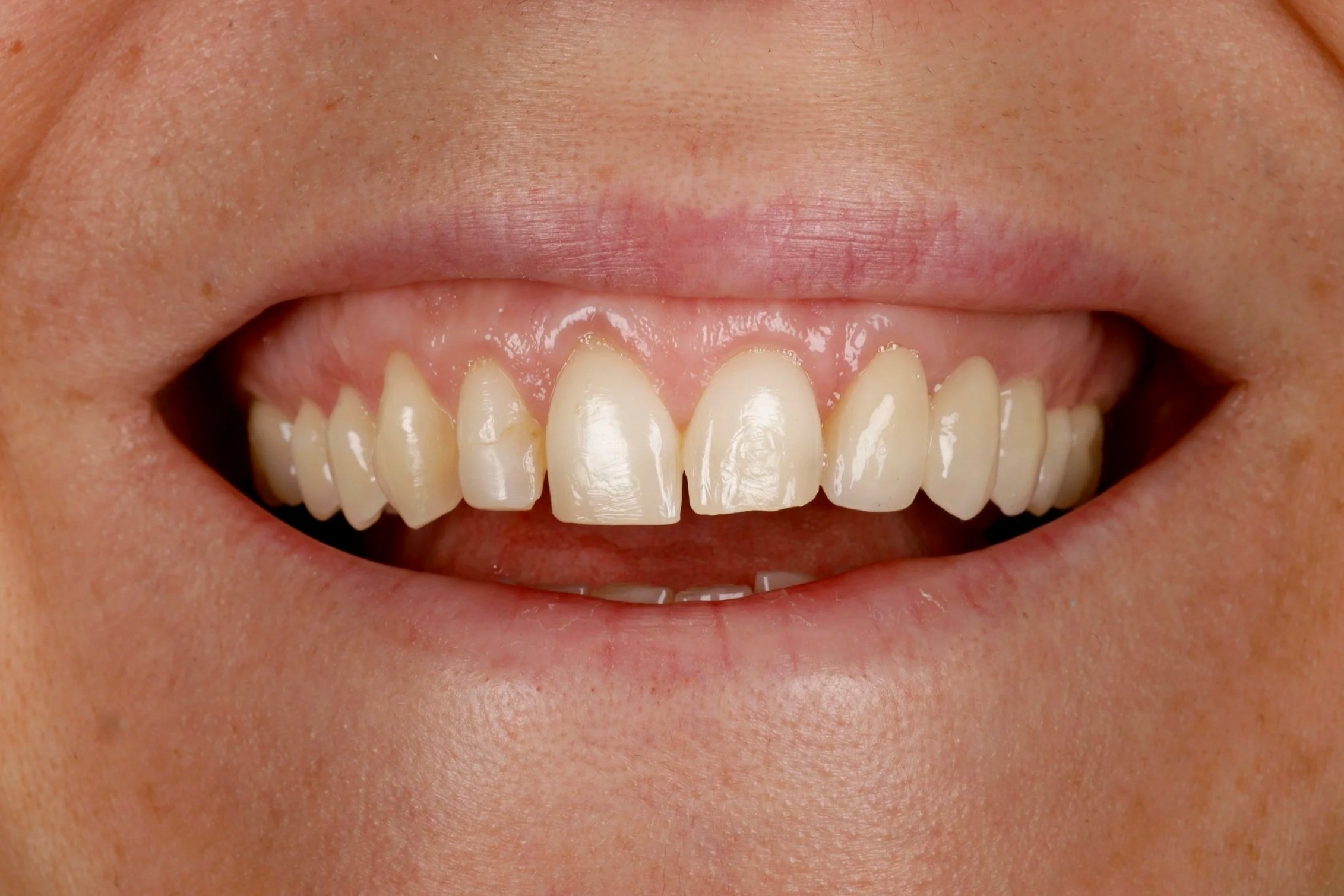 Prima del trattamento di odontoiatria