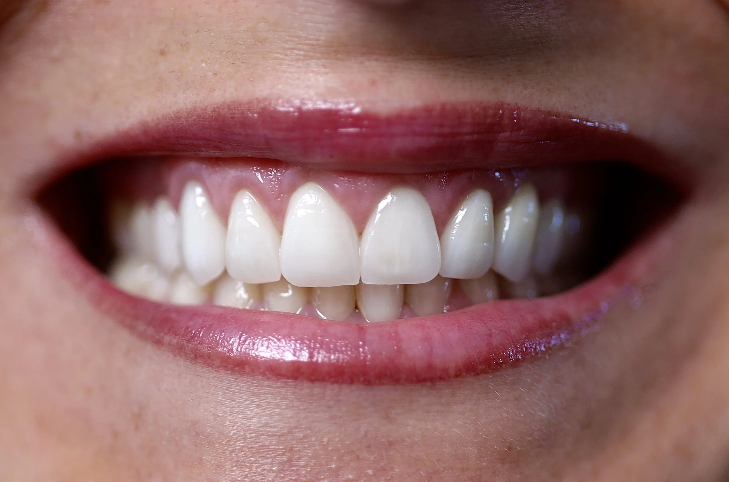 Dopo il trattamento di odontoiatria