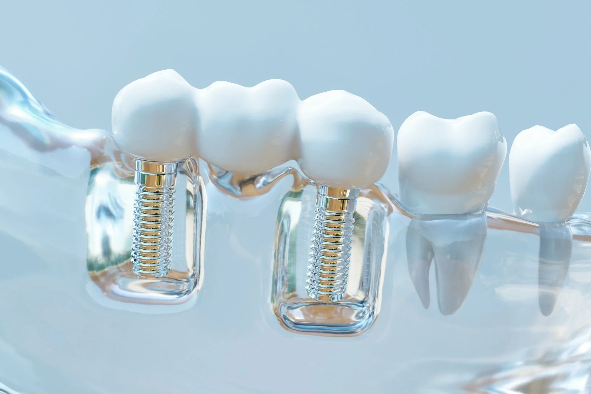 Impianti dentali fatti ad hoc su paziente
