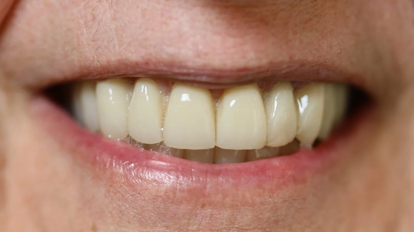 Sorriso naturale dopo il trattamento di odontoiatria estetica