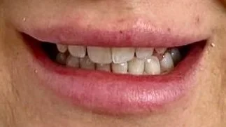 Prima del trattamento di odontoiatria