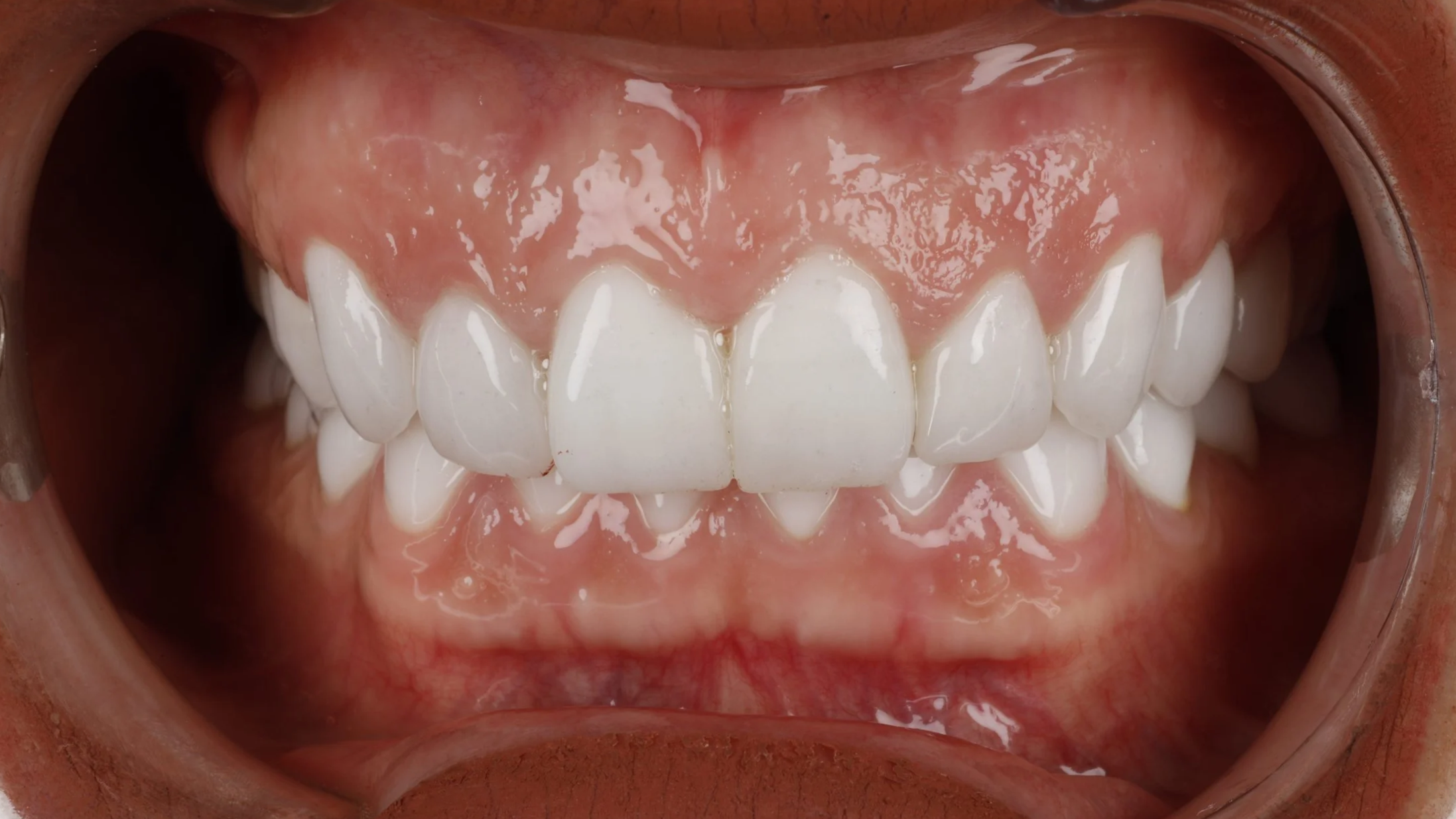 Dopo il trattamento di odontoiatria