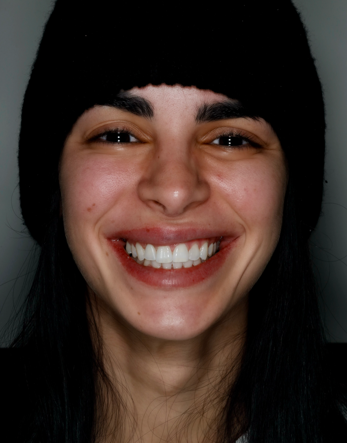Sorriso post gengivectomia