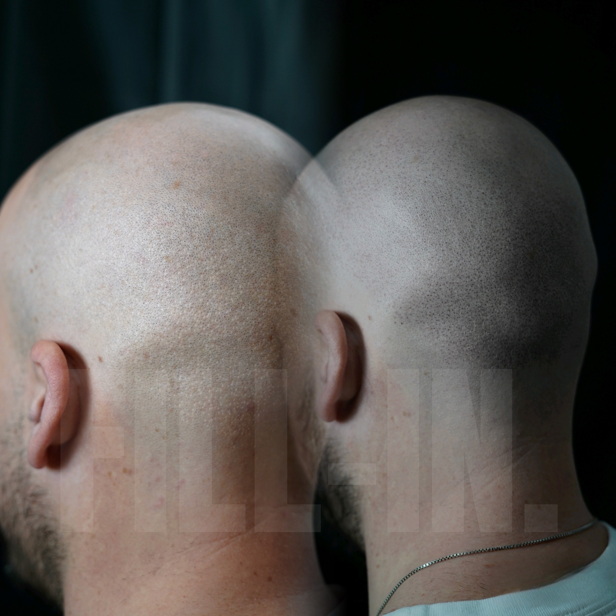 fut narbe pigmentiert