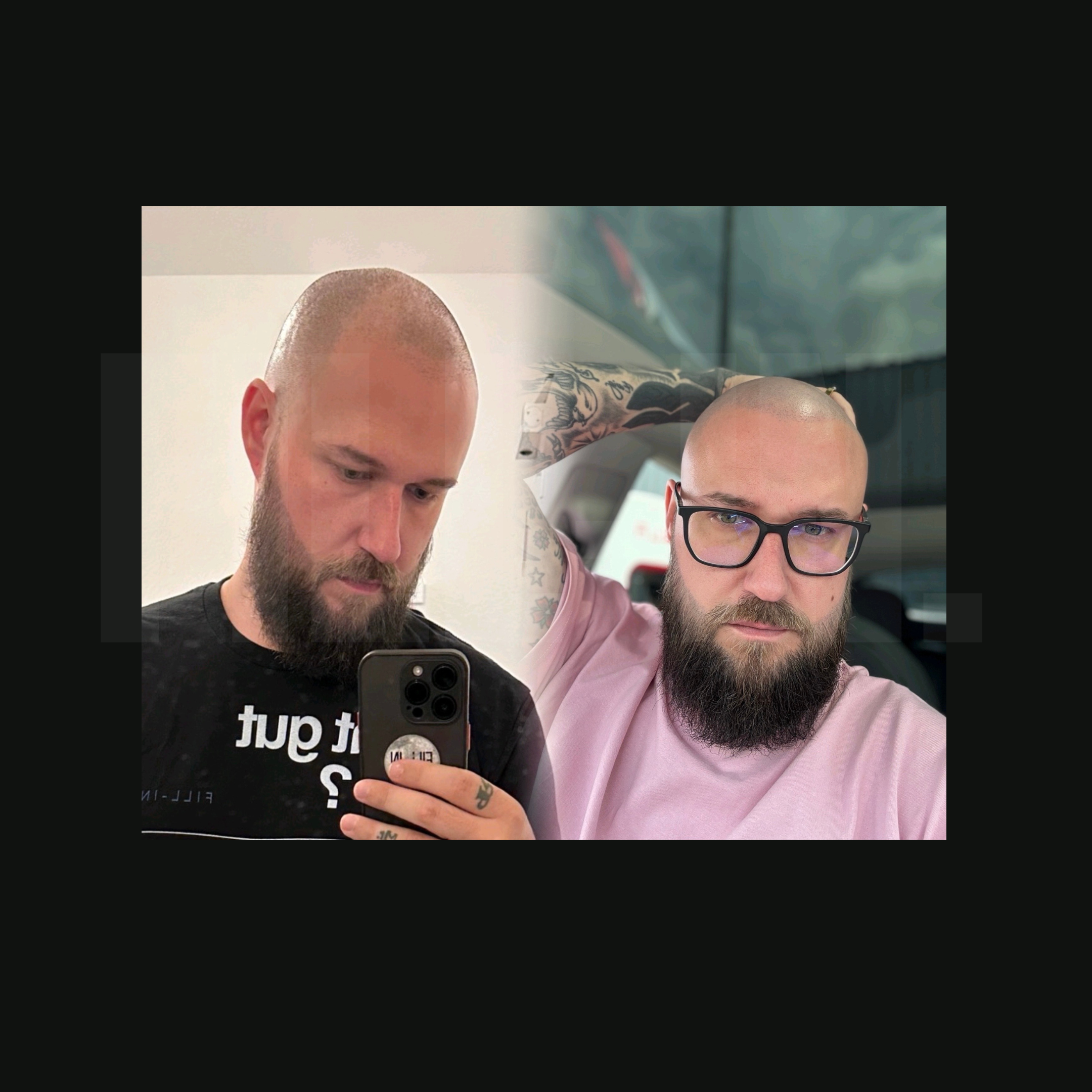 studioleiter mit pigmentierten geheimratsecken