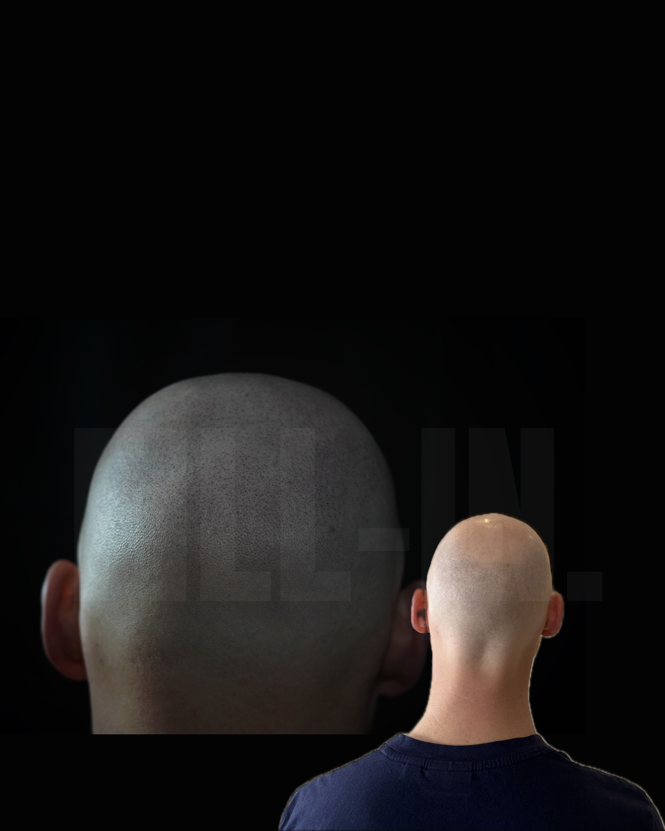 halbglatze pigmentiert