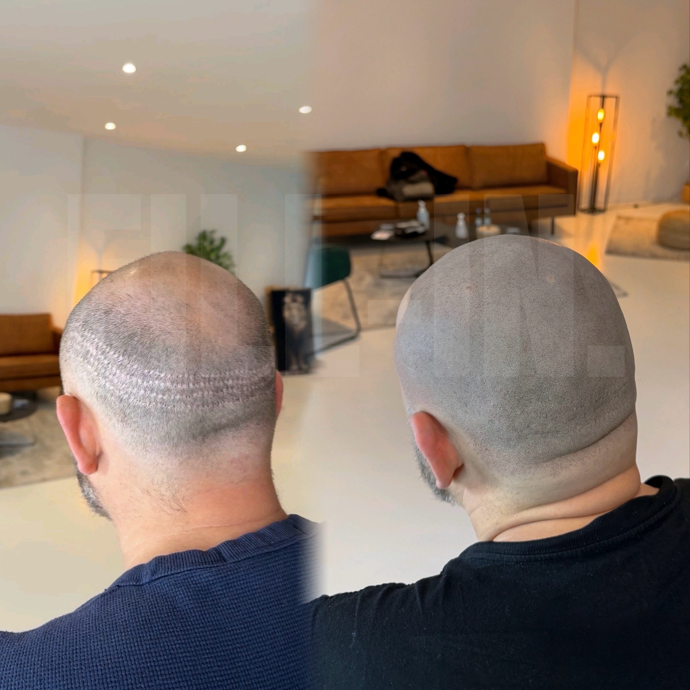 Mann mit Narben von zwei Haartransplantationen