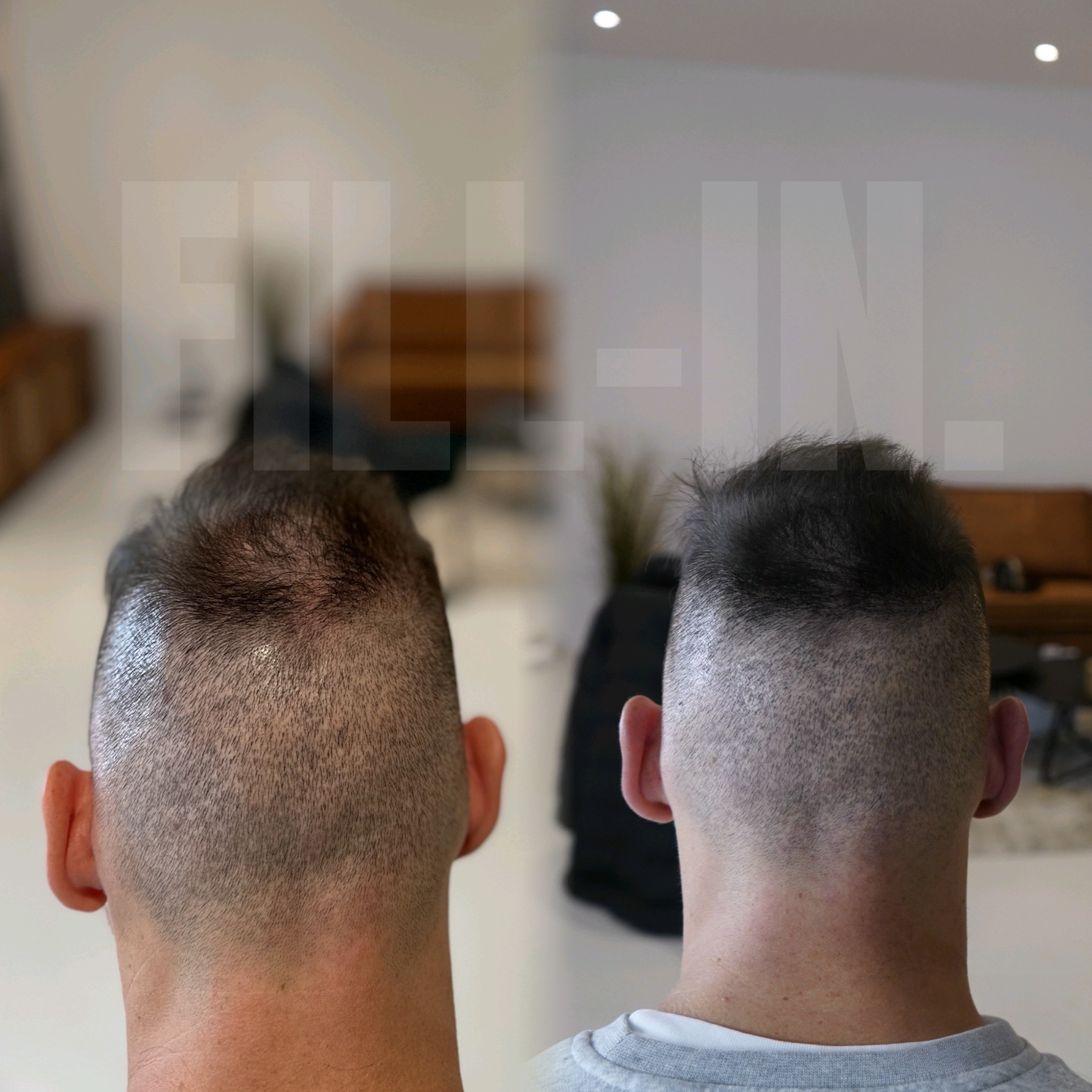 tonsurbereich wurde pigmentiert