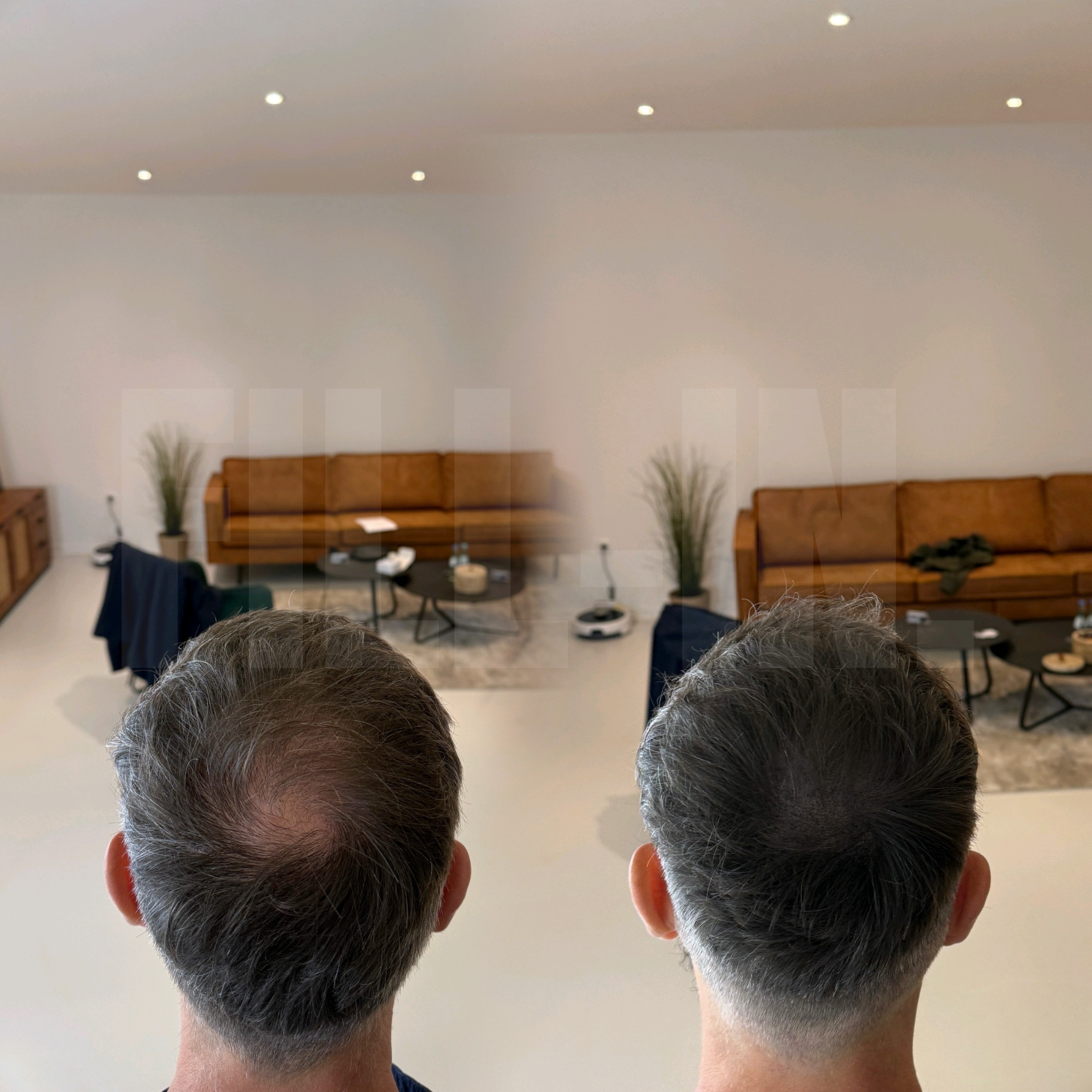 lichtes haar bei einem mann wurde verdichtet