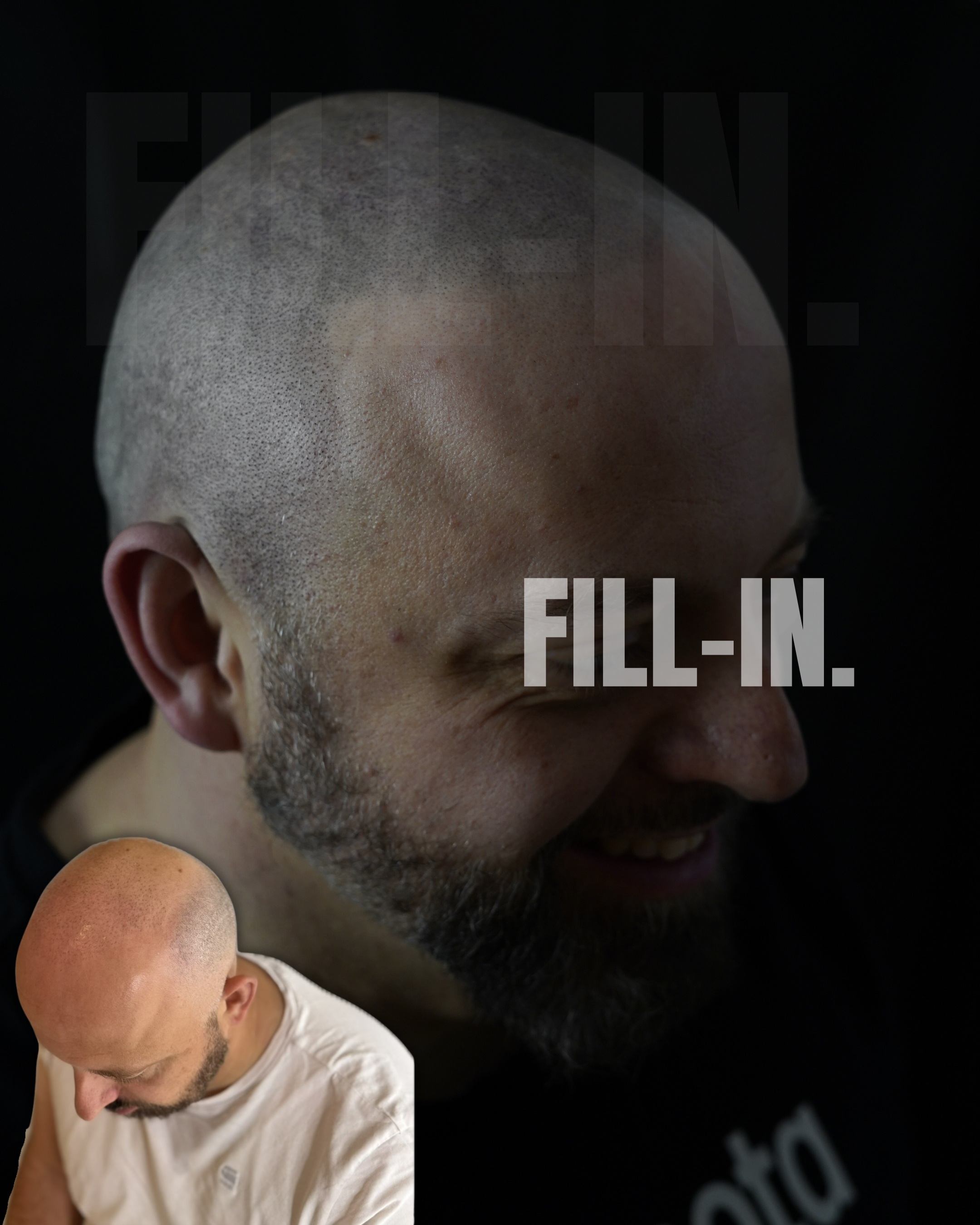 narbenbehandlung und kopfpigmentierung