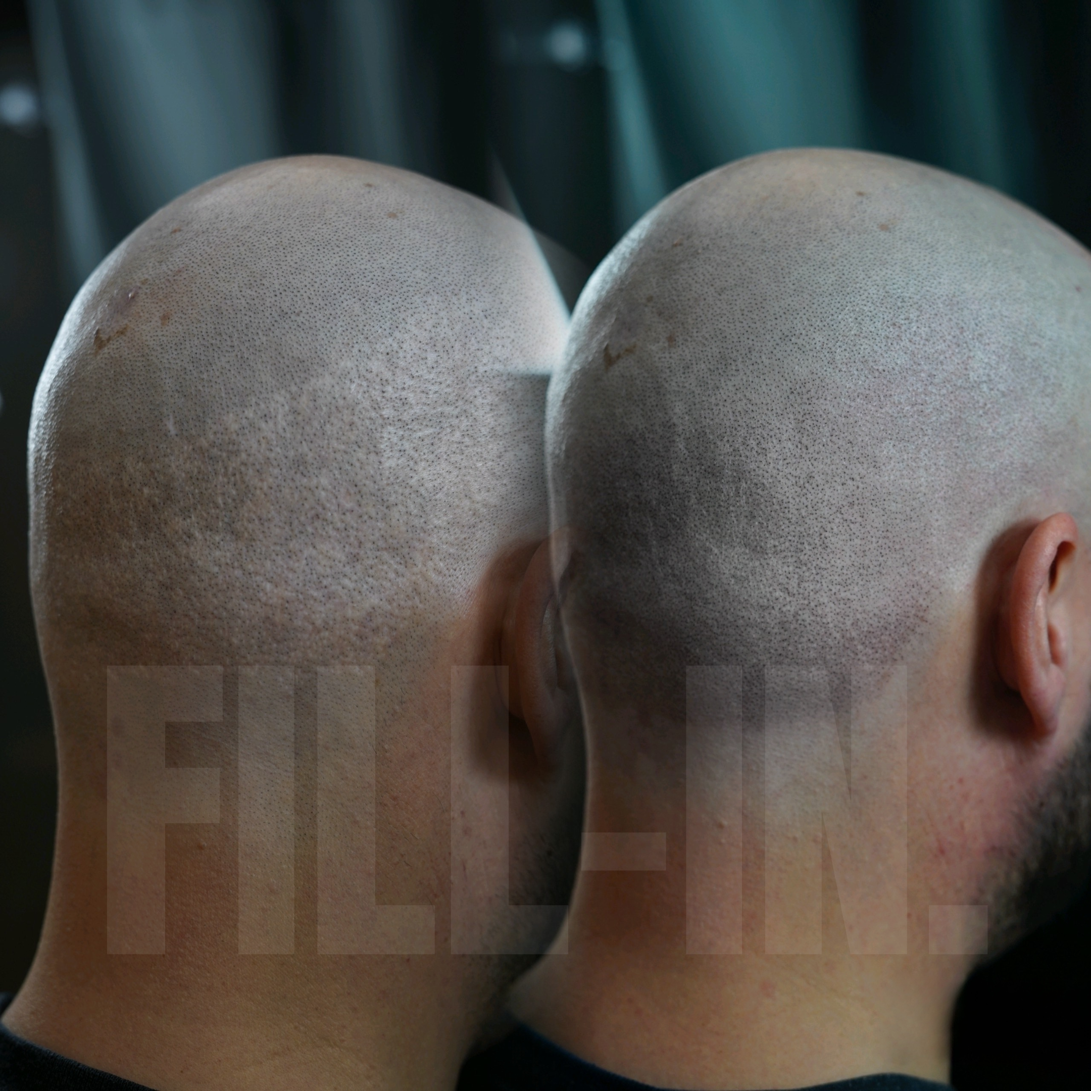 spenderbereich haartransplantation wird pigmentiert
