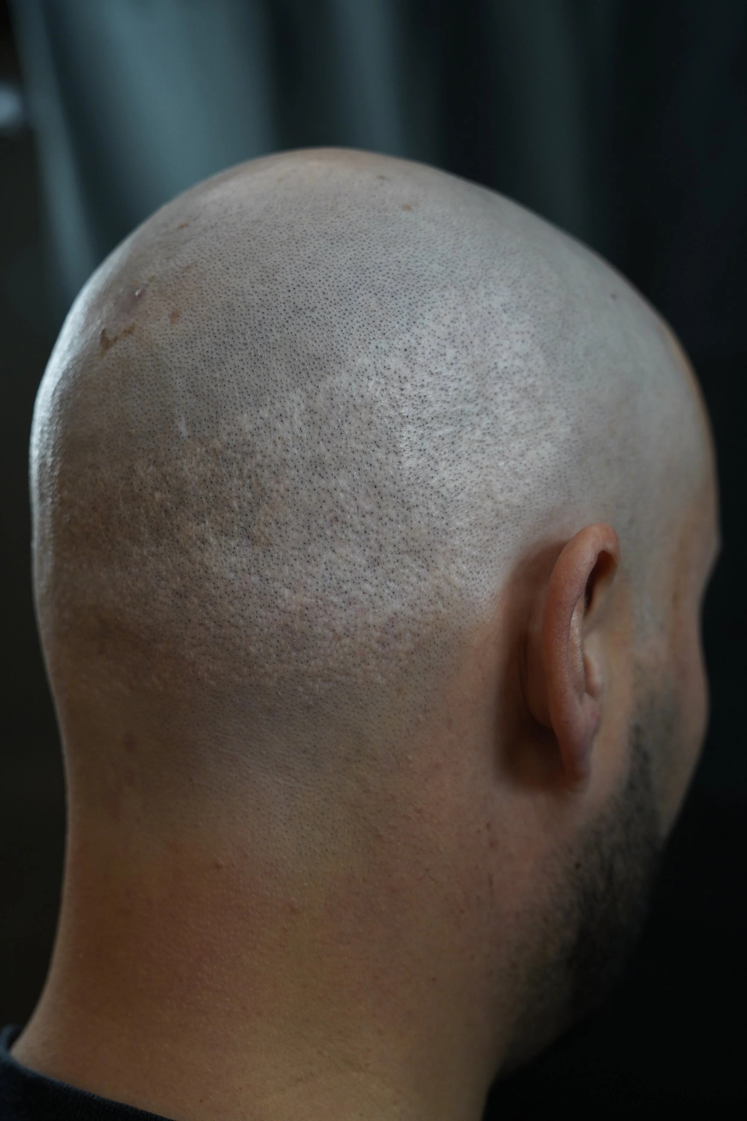 FUT Narbe nach einer Haartransplantation