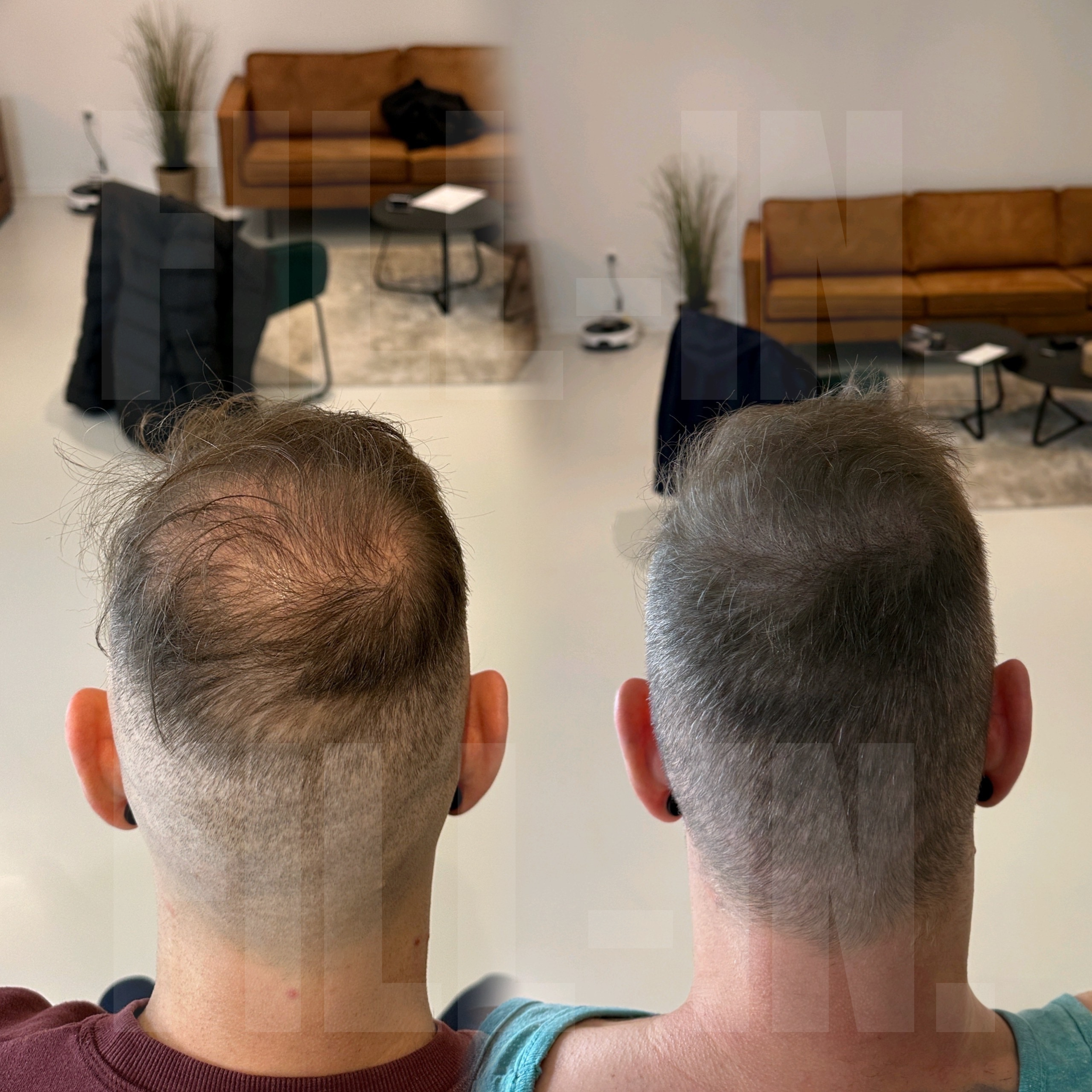 nach zwei haartransplantationen war das haar immer noch licht