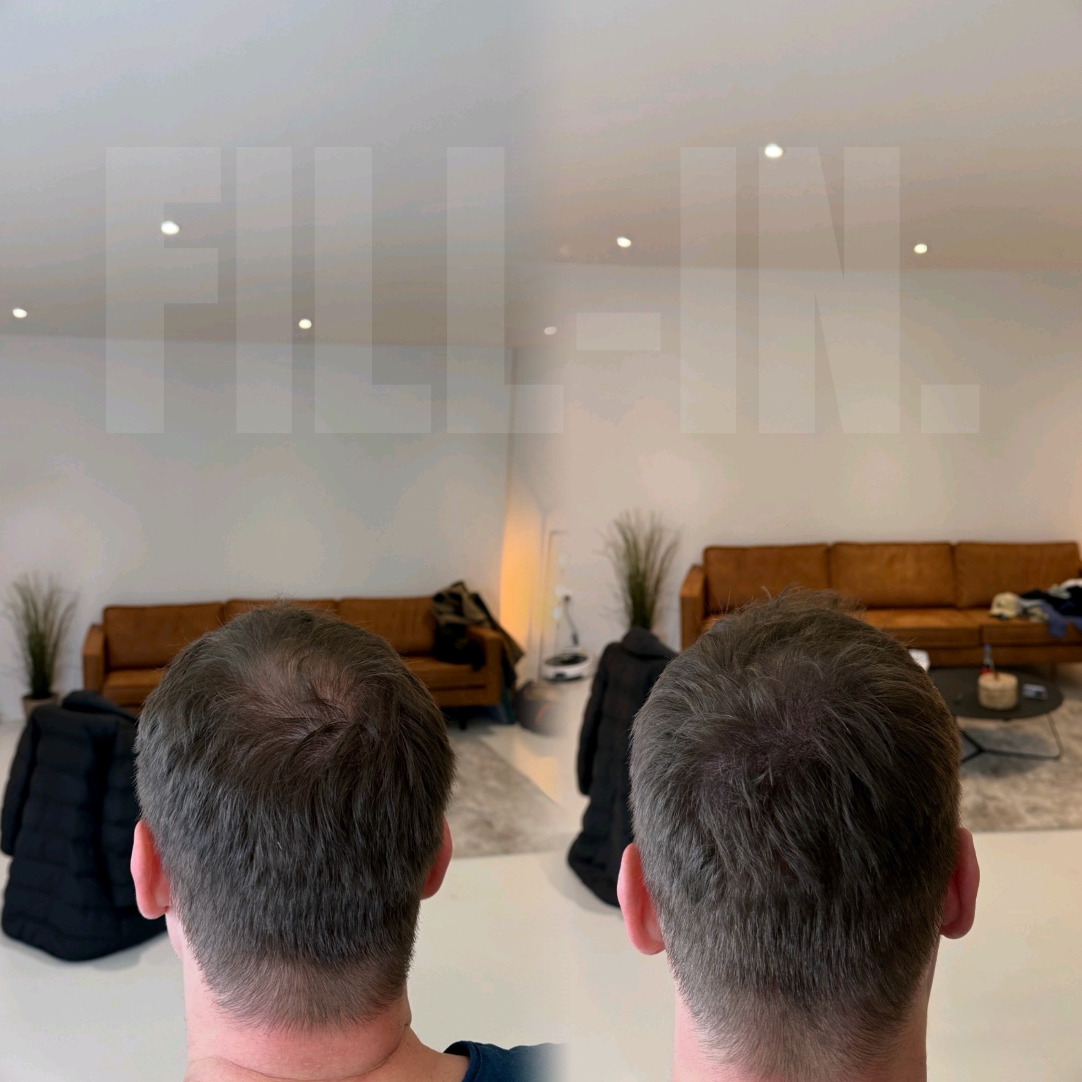 lichter tonsur bereich wurde nach einer haarpigmentierung professionell verdichtet