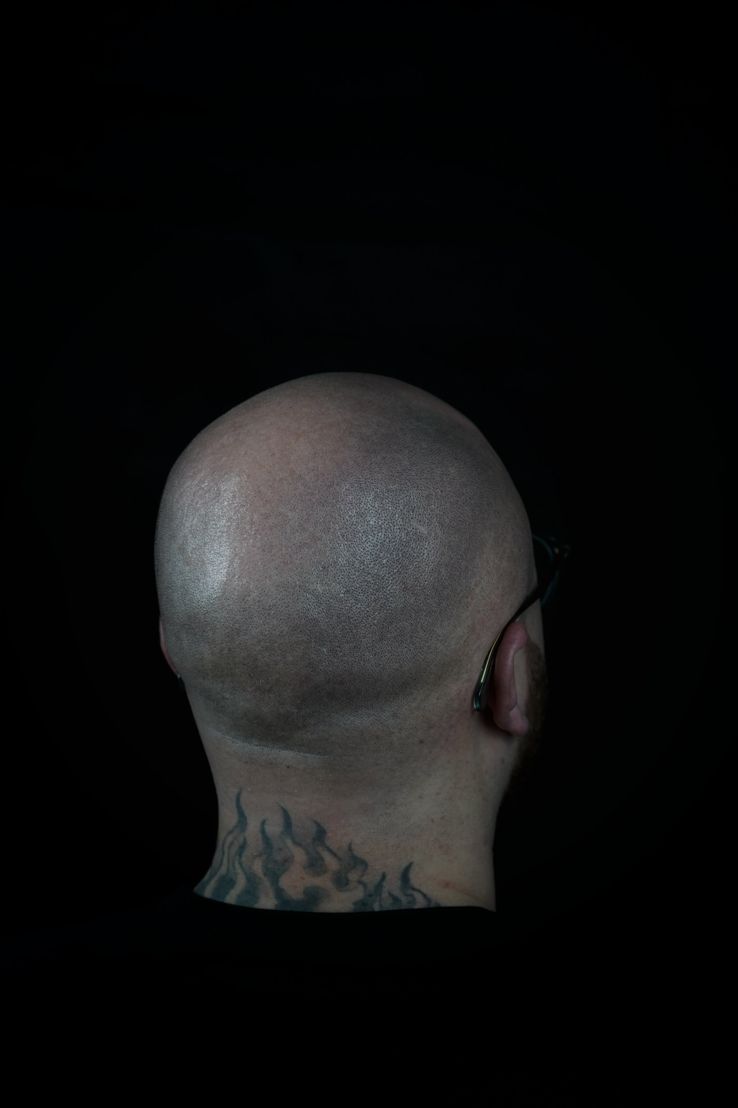Lichte Tonsur eines jungen Mannes vor einer Haarpigmentierung