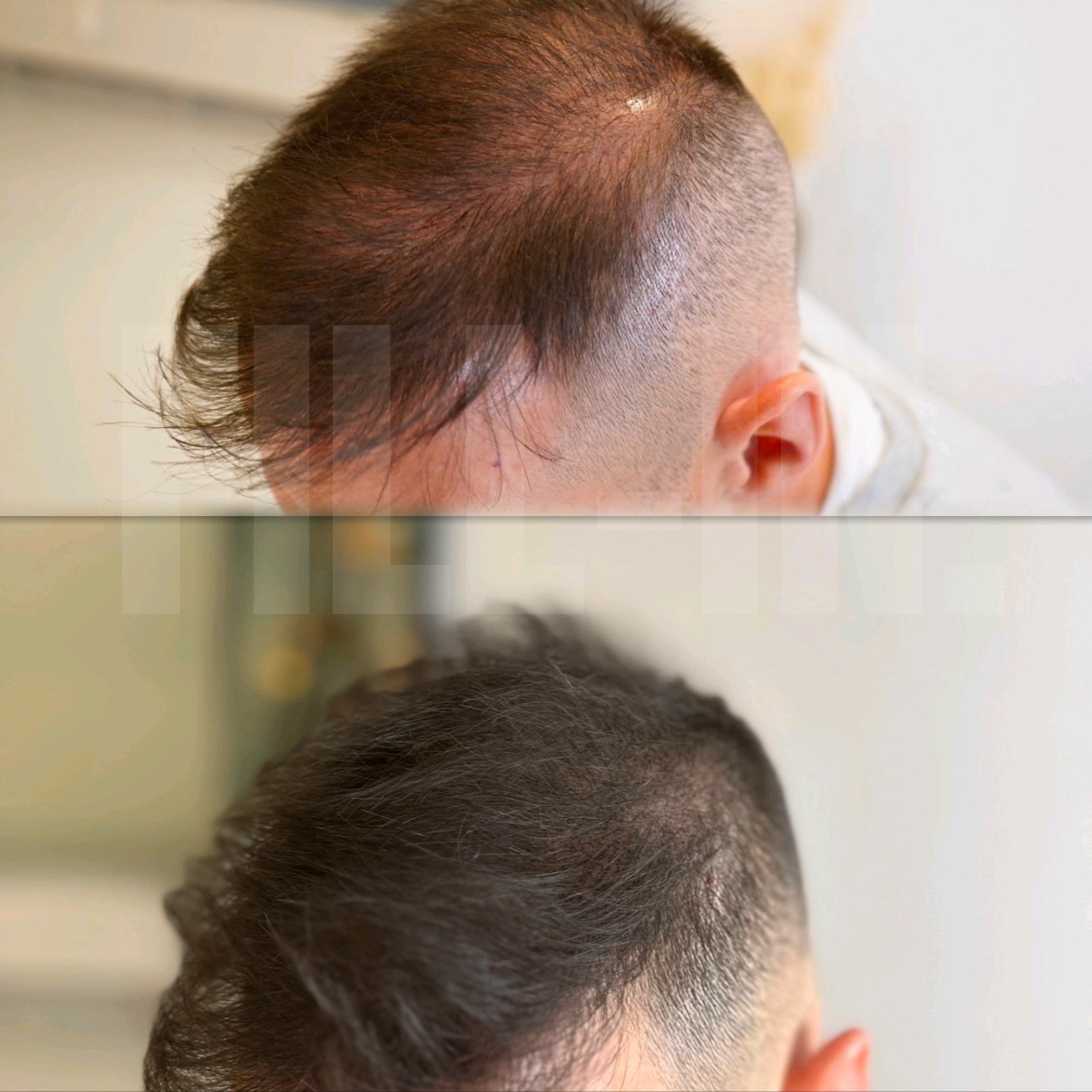 lichtes haar wird dicht