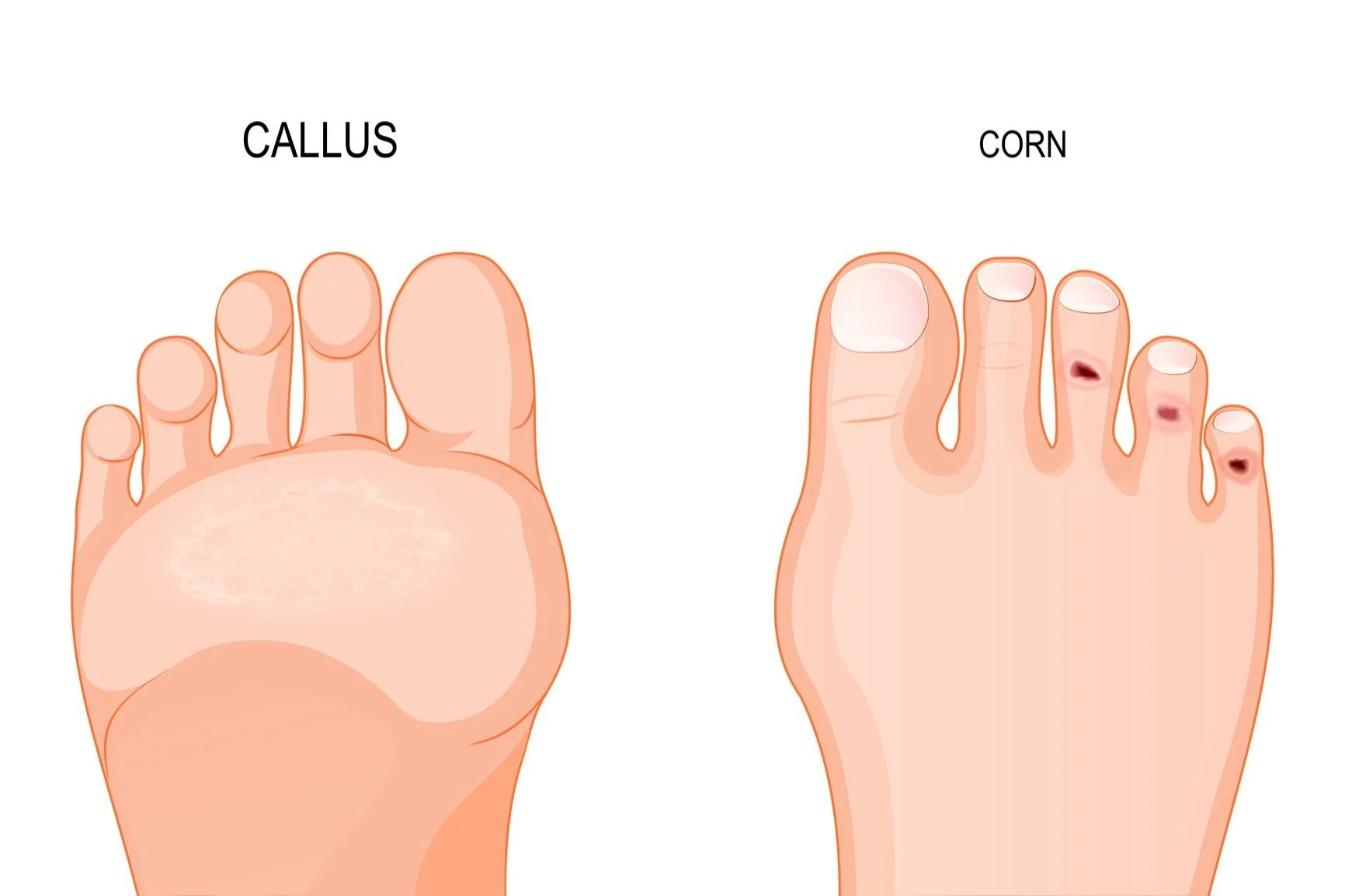 Callus Corn image.jpg
