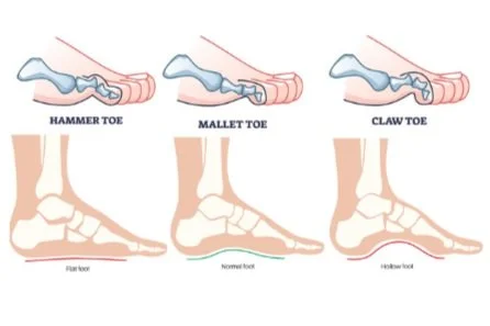 foot deformity.jpg