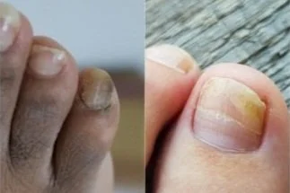 nail fungus.jpg