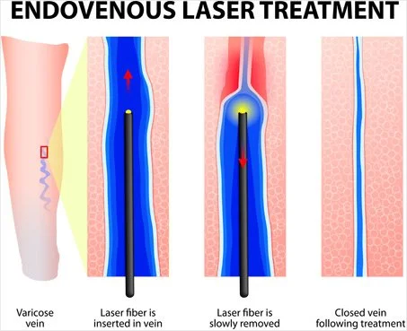 Diagram showing endovenous laser treatment for varicose veins, depicting insertion of laser fiber into the vein, laser fiber removal, and vein closure.
