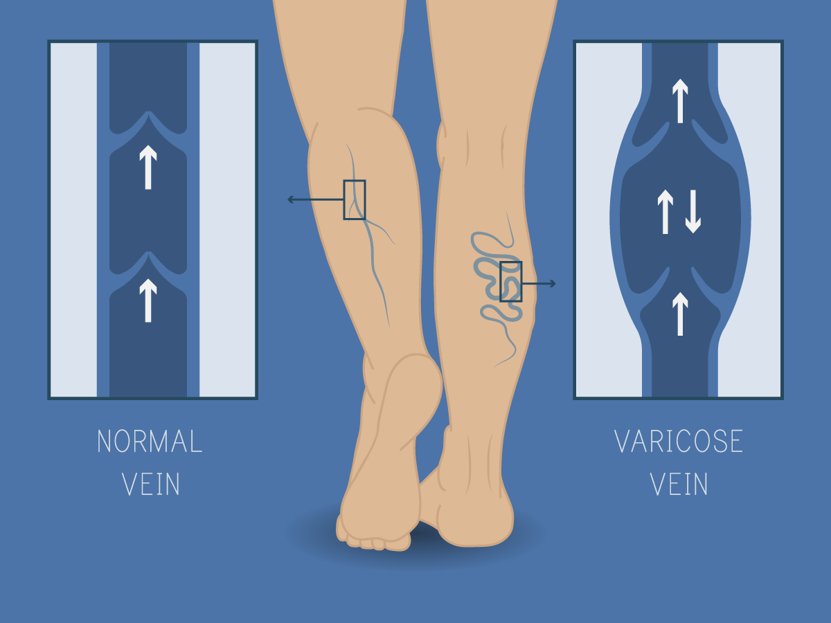 Illustration comparing a normal vein and a varicose vein in the legs, showing the difference in vein structure and blood flow.