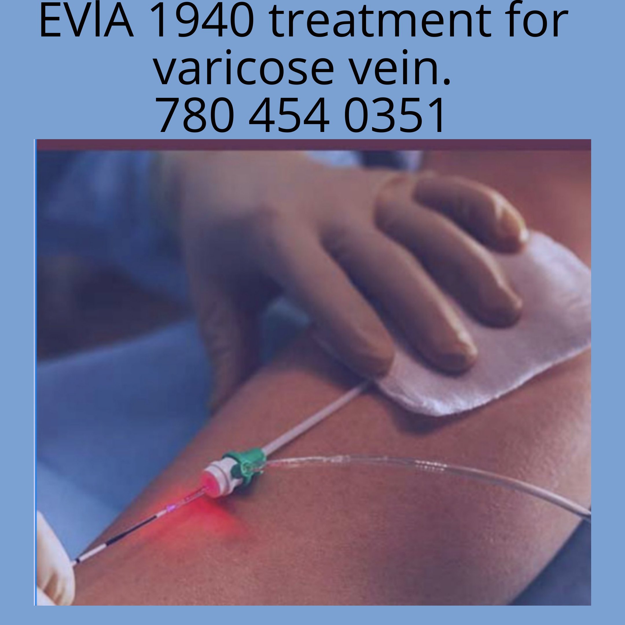EVIA 1940 treatment for varicose veins showing a medical procedure with a healthcare professional applying a treatment to a patient's leg using a laser 1940 for treatment of varicose veins Edmonton