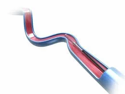 Medical stent inside an artery.