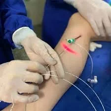 A medical professional performs a EVLA  on a patient's leg, catheter based, no cuts, minimally invasive, minimal down time, newest technology EVLA 1940nm