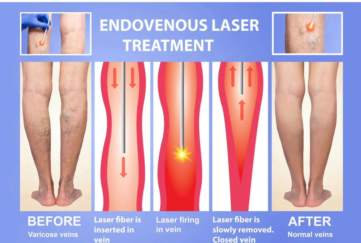 Diagram illustrating endovenous laser treatment for varicose veins, showing before and after images of legs. The treatment involves inserting a laser fiber into the vein, firing the laser to close the vein, and the vein being gradually removed. Before shows varicose veins, after shows normal veins.