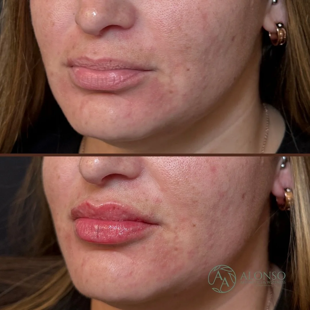 Another home run for a first-time lip filler client, and we only used half a syringe! 👏
&zwnj;
Half a syringe is the perfect starting point for anyone new to filler. It allows you to:
&zwnj;
💉 Ease into the process comfortably
💋 Enhance shape and 