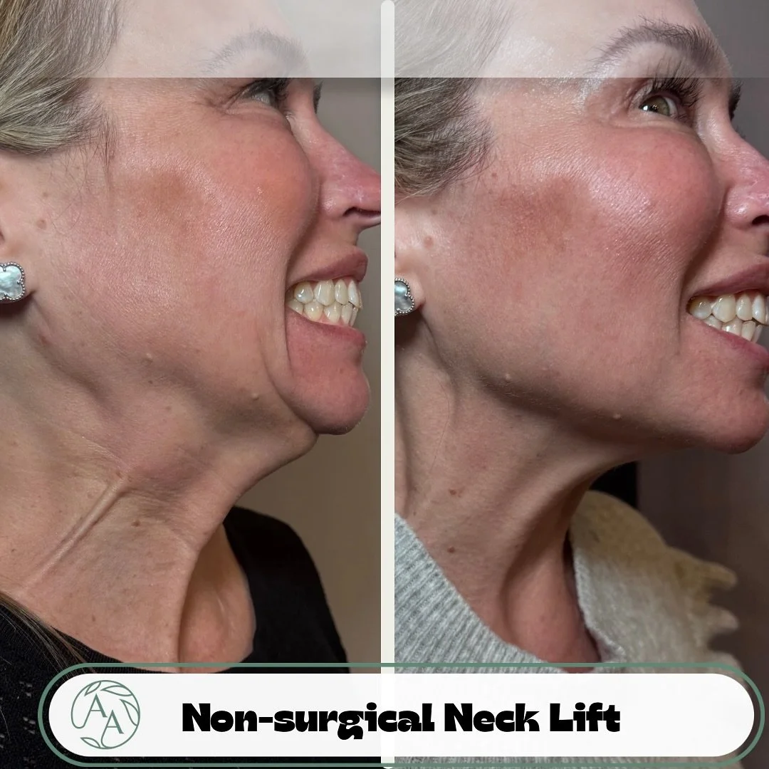 Obsessed with this Nefertiti neck lift on one of my favorite clients using @jeuveaubyevolus 
&zwnj;
The Nefertiti Lift is a non-surgical technique that relaxes the platysma muscle using neuromodulators like Botox or Dysport.
By decreasing vertical ba