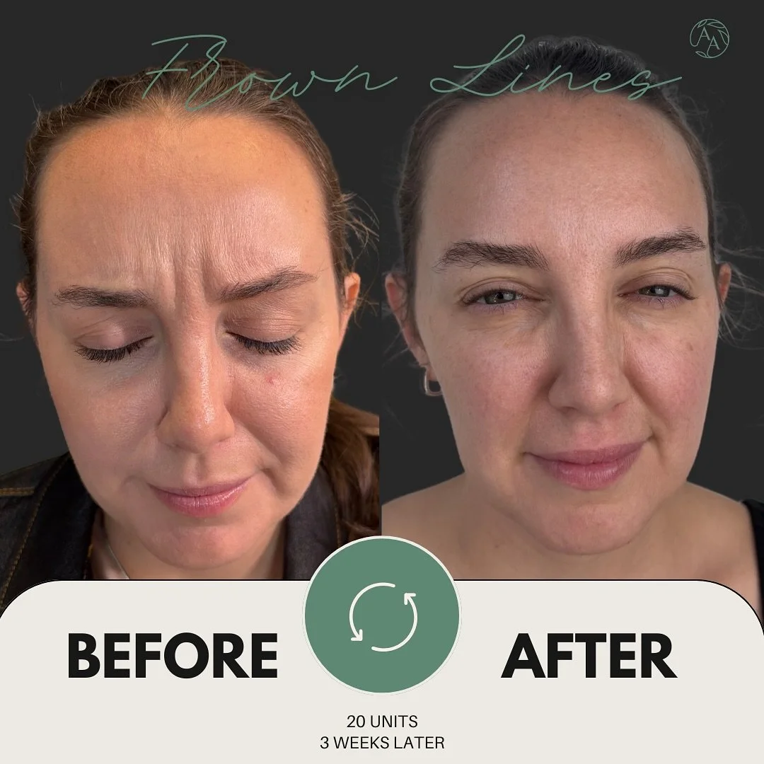 Loving this transformation with 58 units of tox 😍
&zwnj;
 Photos taken three weeks post-treatment. Improved dynamic lines, balanced brow position, and optimized muscle relaxation for a natural, refreshed appearance.
-
-
-
-
👩🏻&zwj;⚕️Gwen Alonso, A